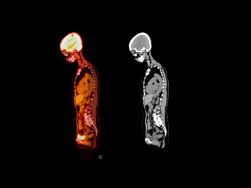 What is a PET scan and how does it help in diagnosing cancer? | Dr. Asma Pathan | MOC Kalyani Nagar